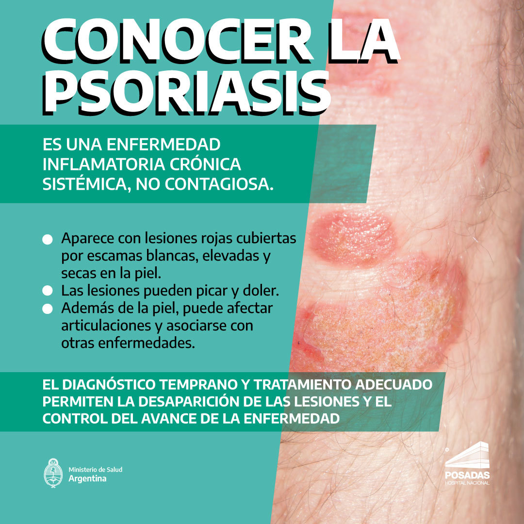 Psoriasis Argentinagobar